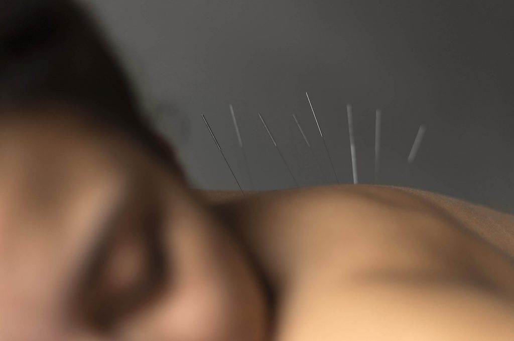 Acupuncture-sans-douleur